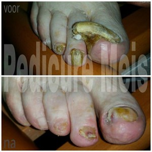 Voor na